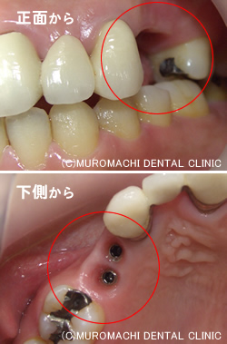 インプラント手術前