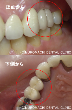 インプラント手術後